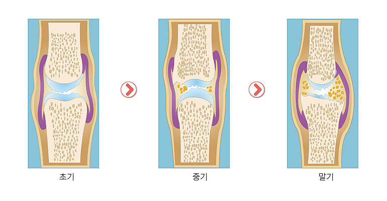 일산 무릎관절염 퇴행성 진행단계별 증상에 따른 치료방법